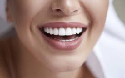 Carillas Dentales; ¿Qué son y cómo Cuidar las Carillas Dentales?