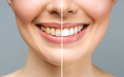 Como Evitar que los Dientes se Manchen