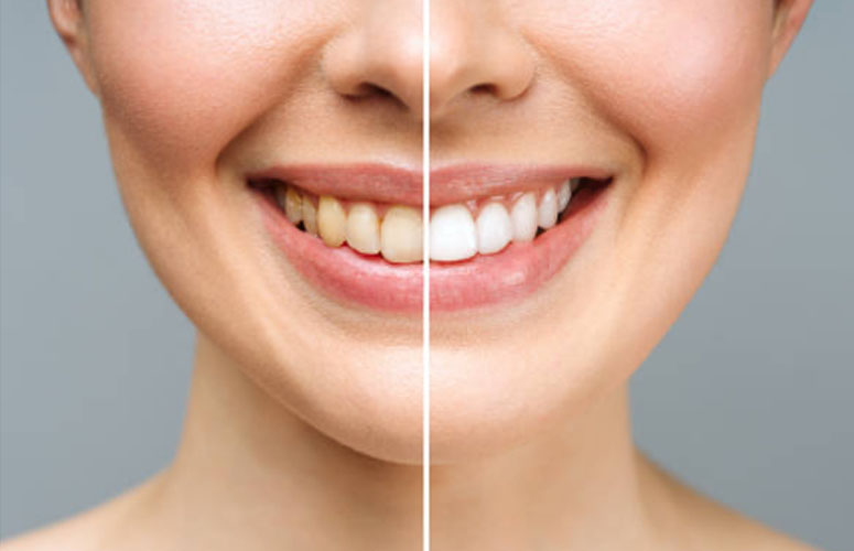 Consejos para Evitar se Manchen los Dientes