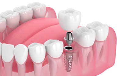 Diferencias entre Implantes y Prótesis Dentales