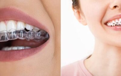 Diferencia entre Ortodoncia Invisible y Brackets Estéticos